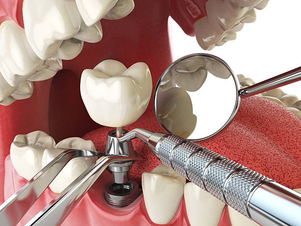 Best Emergency Treatment for Dental Infections or Abscesses in Memphis, FL